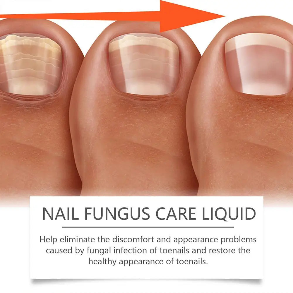 Onychomycosis Hand Foot Removal Repair Care Nail Fungal Treatment Serum Anti Infection Toe Fungus Paronychia 50g