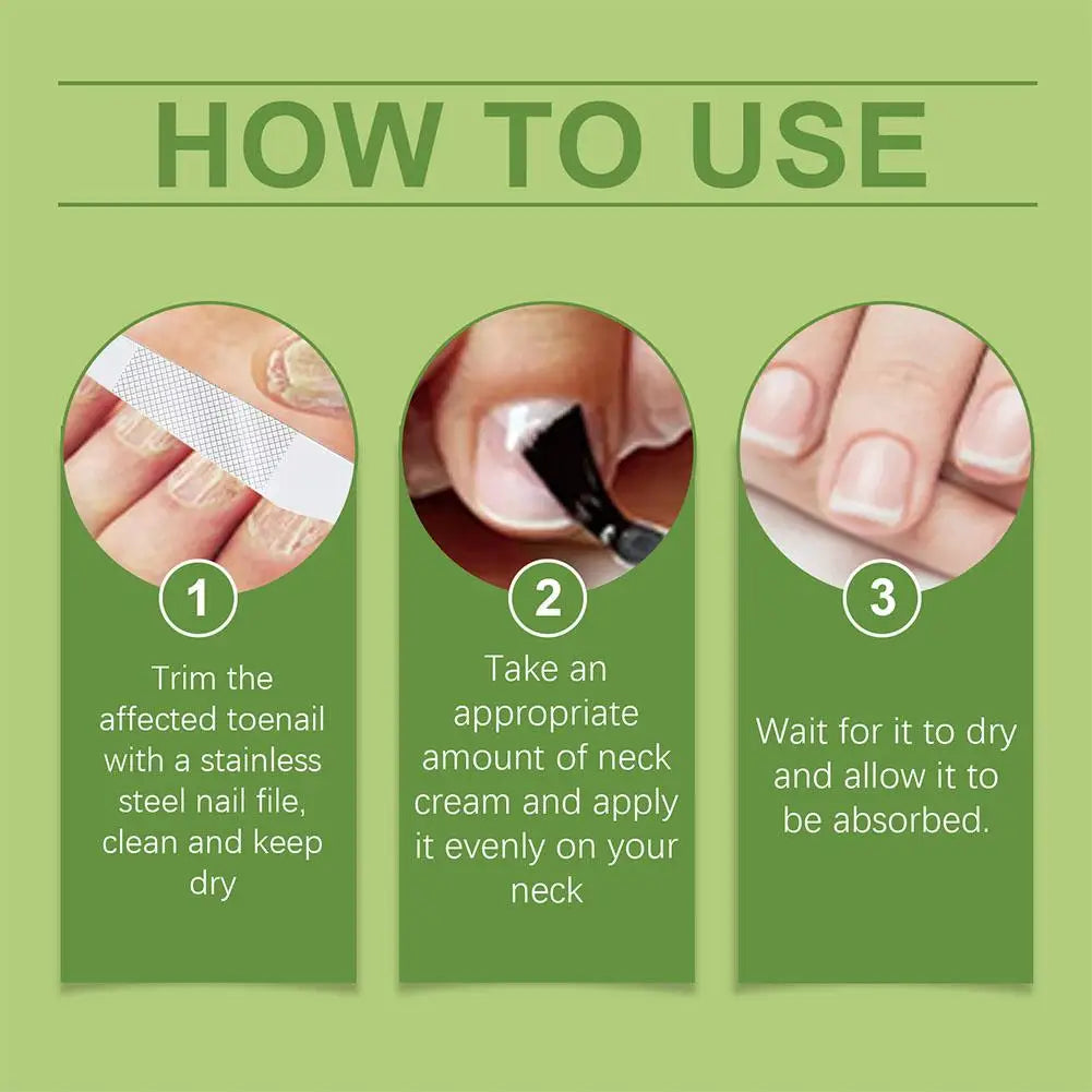 Onychomycosis Hand Foot Removal Repair Care Nail Fungal Treatment Serum Anti Infection Toe Fungus Paronychia 50g